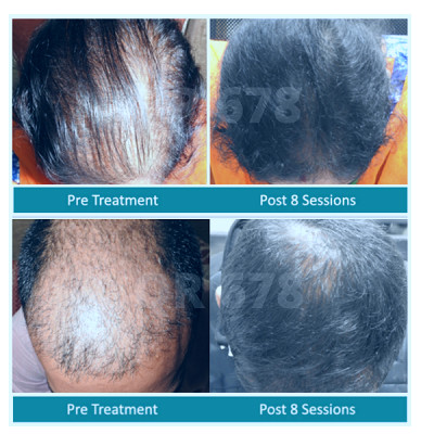 Best & Latest Hair Loss Treatment for Men and Women in India 2021